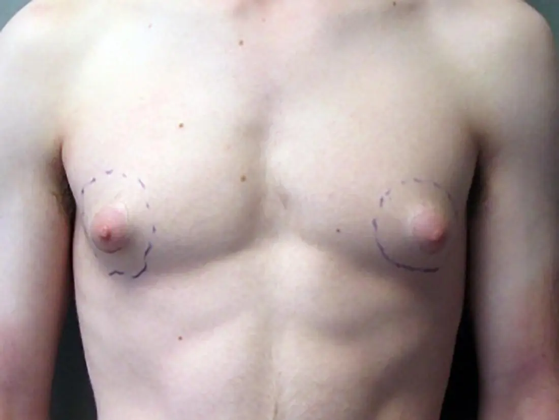 large puffy nipple