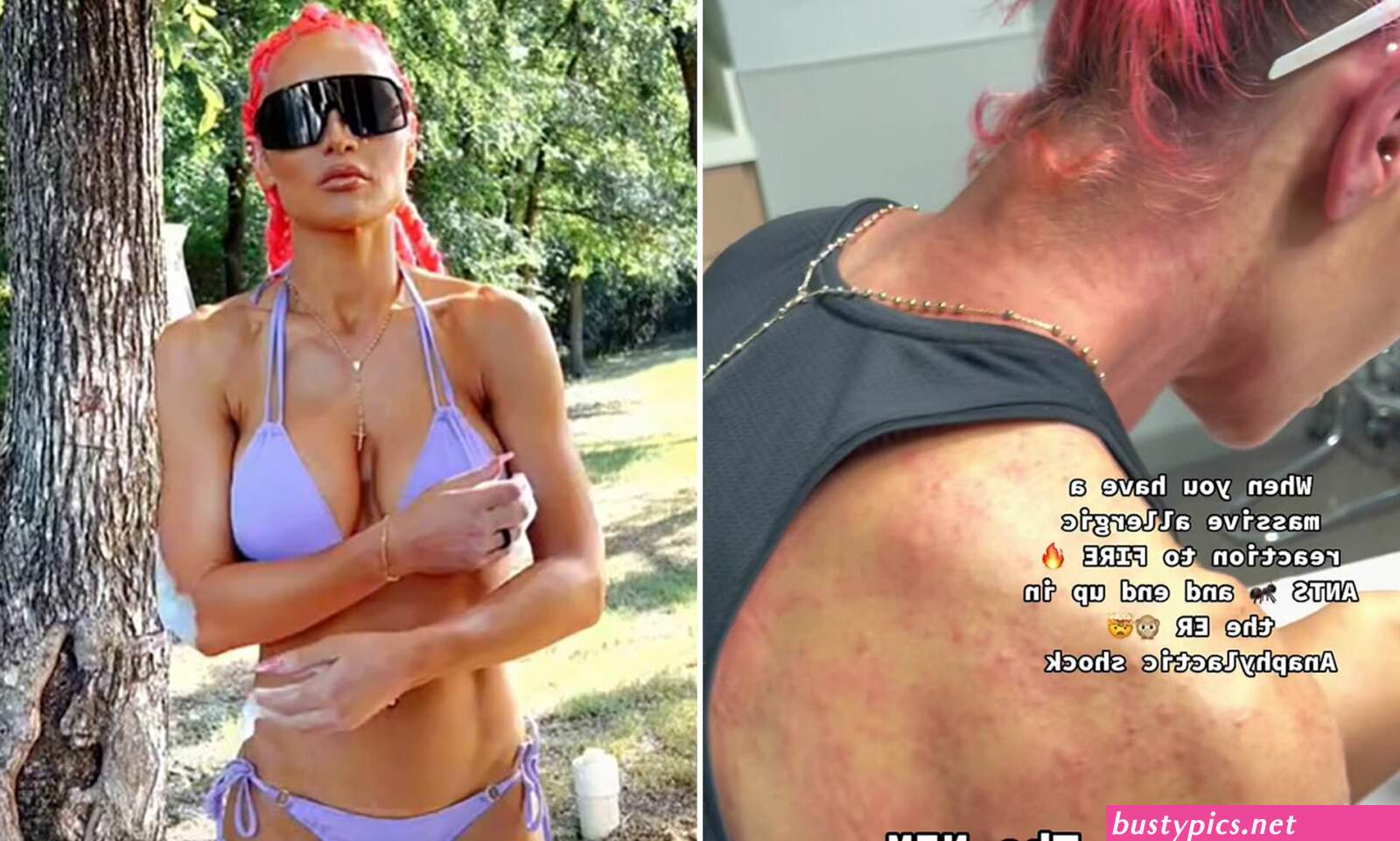 ant bites xxx